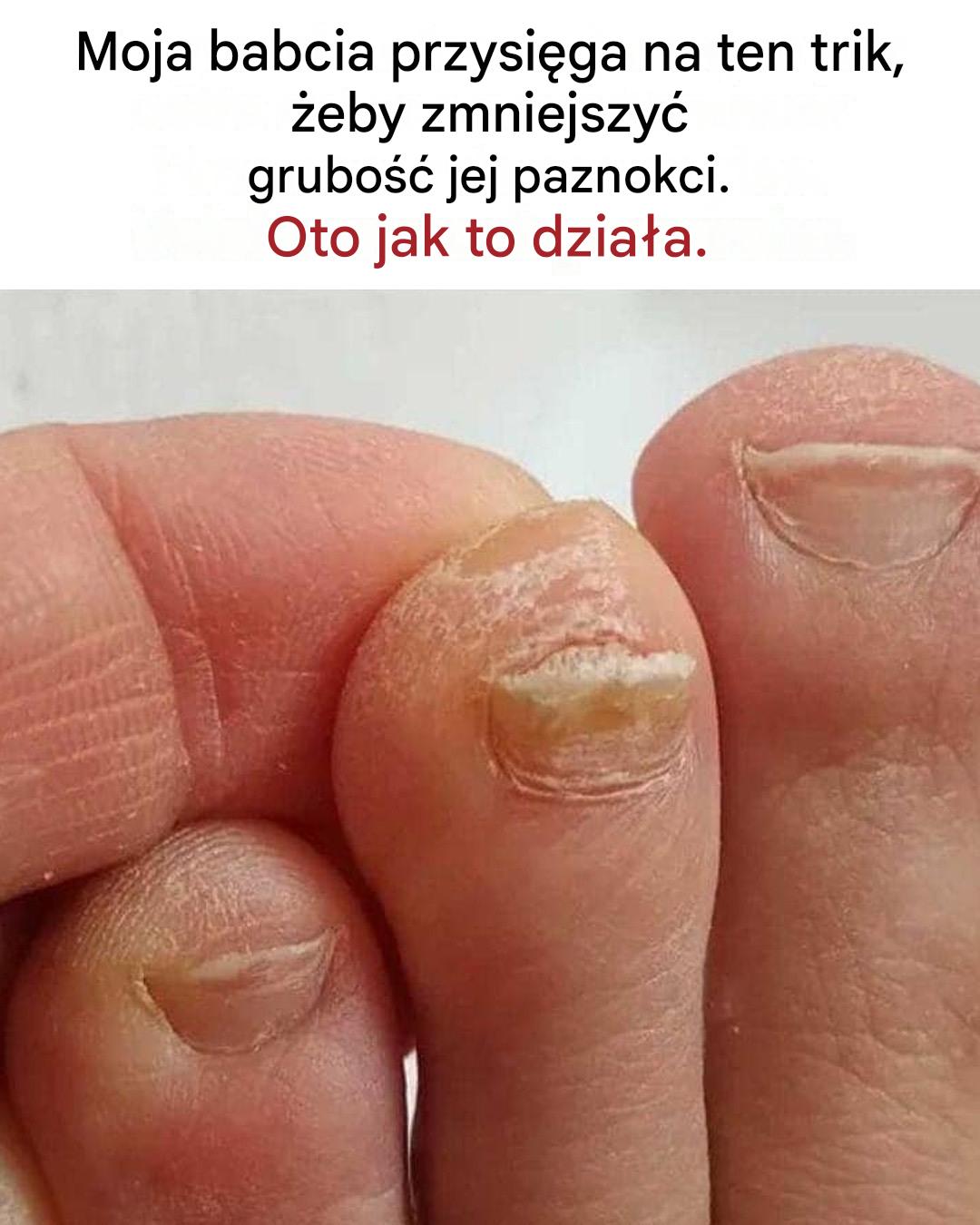 Sztuczka na zmniejszenie grubości paznokci u stóp