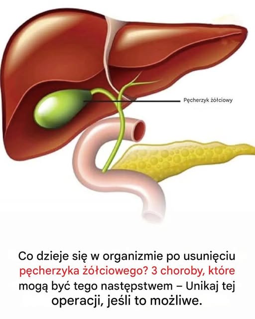 Mało znane konsekwencje usunięcia pęcherzyka żółciowego: wpływ na zdrowie, który należy monitorować