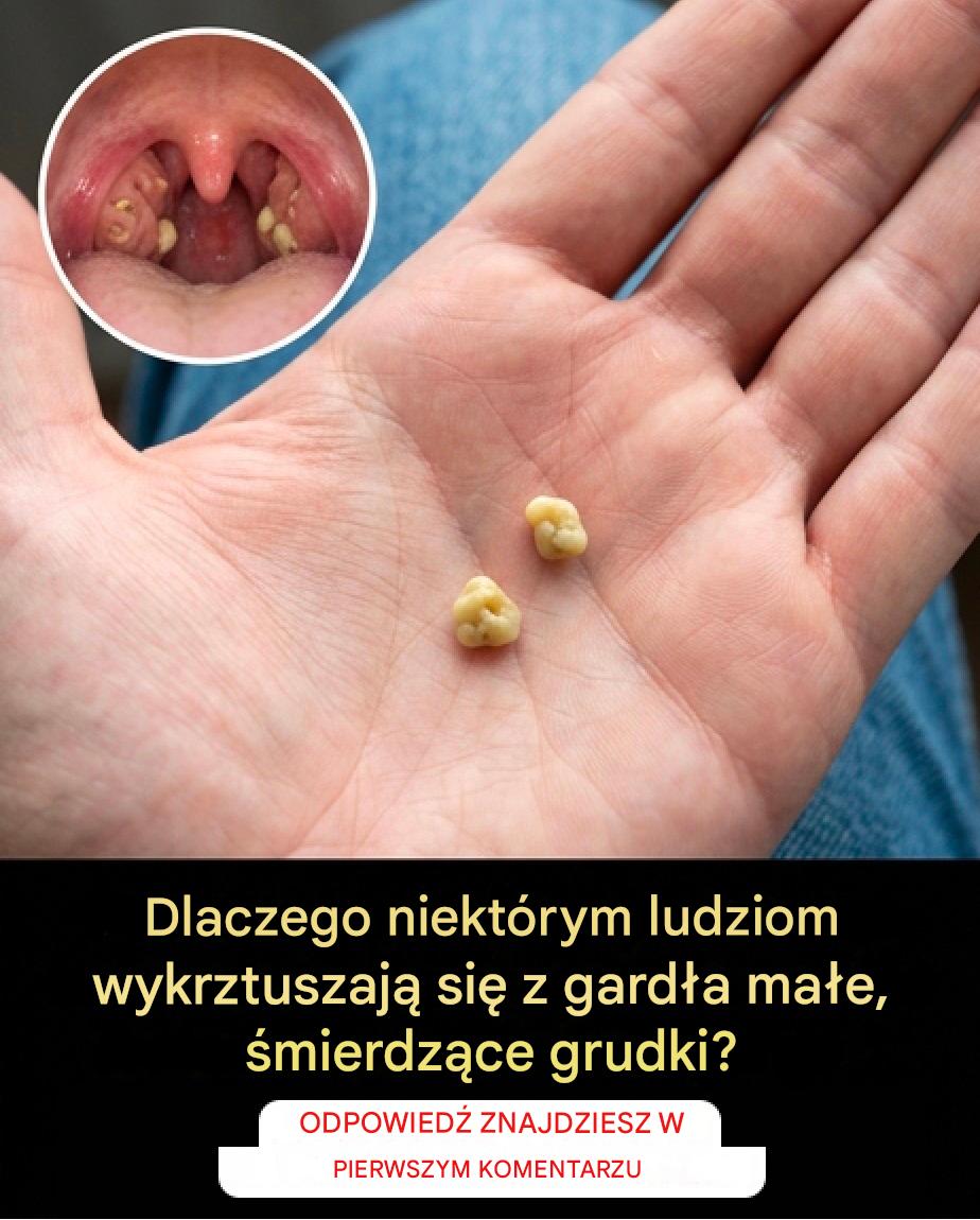 Kamienie żółciowe: czym są i jak się ich pozbyć?