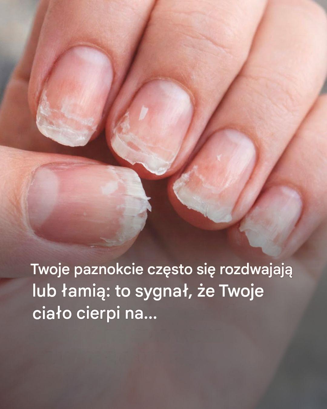 Twoje paznokcie łamią się i rozdwajają: ten szczegół może wskazywać na problem…Zobacz więcej