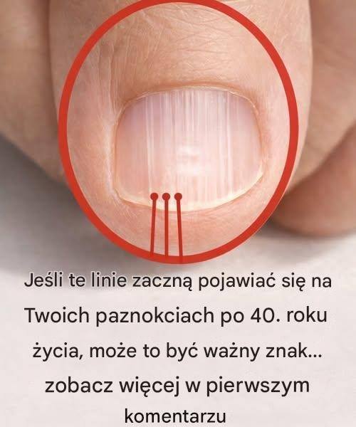 Jeśli po 40. roku życia na twoich paznokciach pojawia się linia, może to być znak ostrzegawczy… Zobacz pierwszy komentarz.