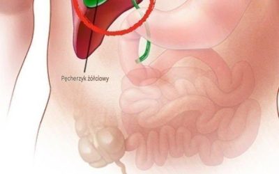 Co dzieje się z ciałem po usunięciu pęcherzyka żółciowego? 3 choroby, które mogą wystąpić – unikaj operacji, jeśli to możliwe