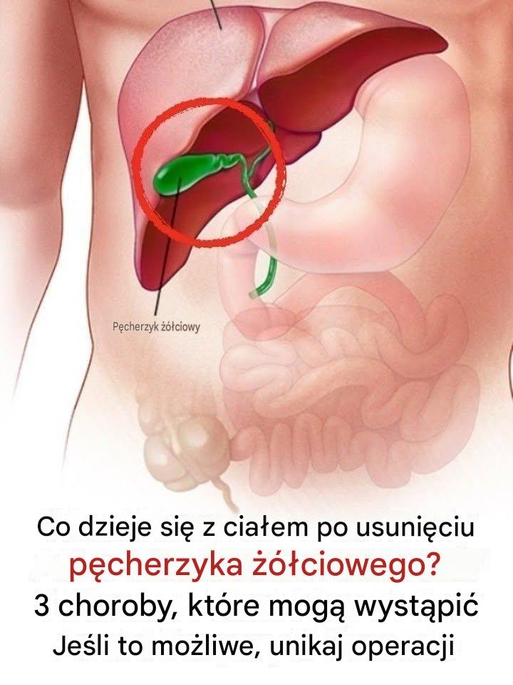 Co dzieje się z ciałem po usunięciu pęcherzyka żółciowego? 3 choroby, które mogą wystąpić – unikaj operacji, jeśli to możliwe