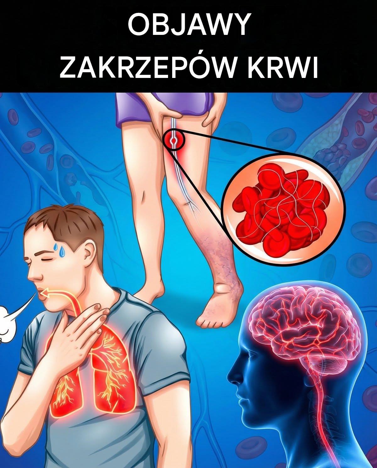 Oznaki ostrzegawcze zakrzepów krwi