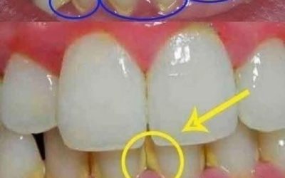 Usuń płytkę nazębną w 5 minut naturalnie, bez wizyty u dentysty.