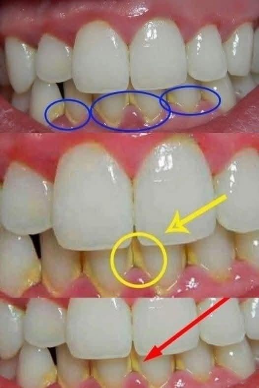 Usuń płytkę nazębną w 5 minut naturalnie, bez wizyty u dentysty.