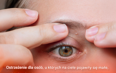Ostrzeżenie dla osób z małymi białymi plamkami pojawiającymi się na całym ciele: lekarz wyjaśnia, jak się ich pozbyć