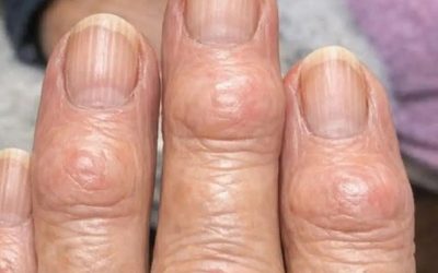 👵🖐️ Moja babcia ma małe, twarde guzki na palcach, w pobliżu paznokci… dlaczego to się rozprzestrzenia? 😮🔍 To powszechne zjawisko związane z wiekiem, które intryguje wiele osób 👀🦴 Czy zauważyłeś to kiedyś u kogoś? 🤔👇💬