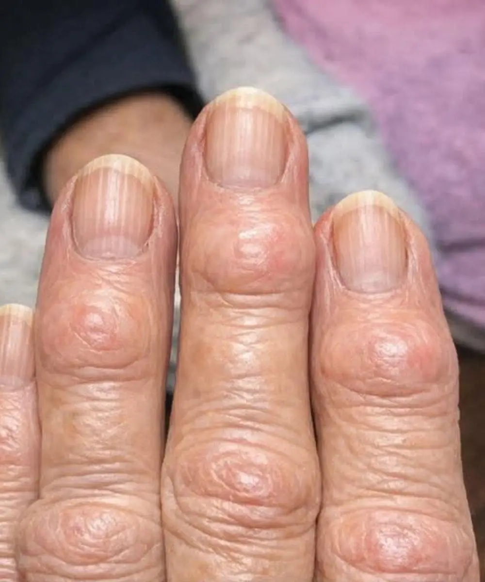 👵🖐️ Moja babcia ma małe, twarde guzki na palcach, w pobliżu paznokci… dlaczego to się rozprzestrzenia? 😮🔍 To powszechne zjawisko związane z wiekiem, które intryguje wiele osób 👀🦴 Czy zauważyłeś to kiedyś u kogoś? 🤔👇💬