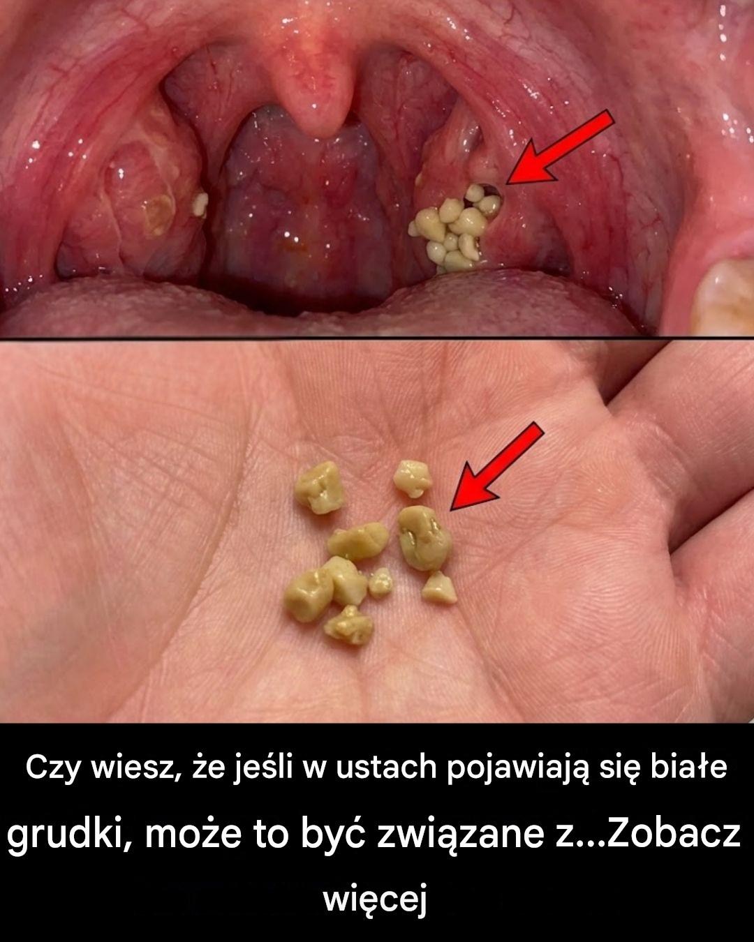 Kamienie żółciowe: czym są i jak się ich pozbyć?