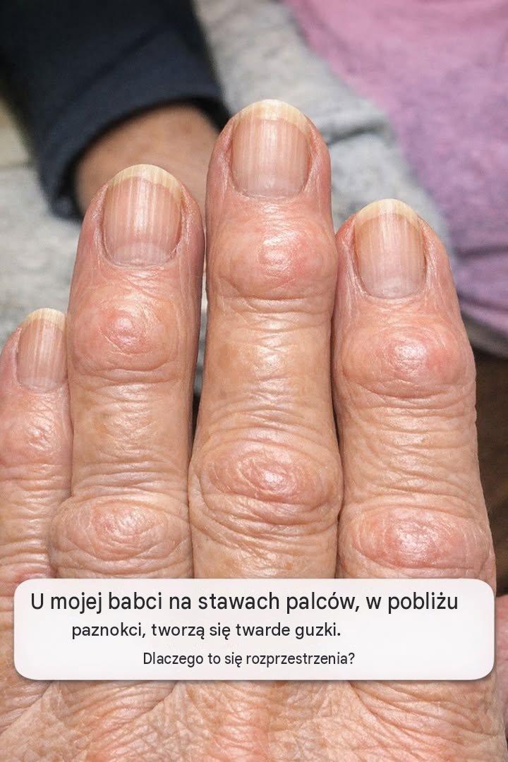 U mojej babci na stawach palców, przy paznokciach, tworzą się twarde guzki. Dlaczego się rozprzestrzeniają?